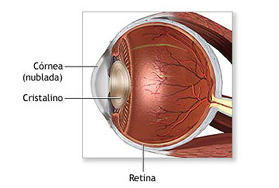 Transplante de Cornea